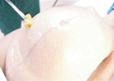 TYE1801 – Barriga vestível de cesárea